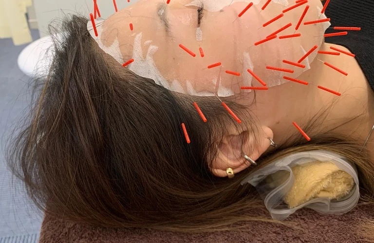 若返りを叶える美容鍼で目元のたるみを改善し、見た目年齢を引き締める秘訣