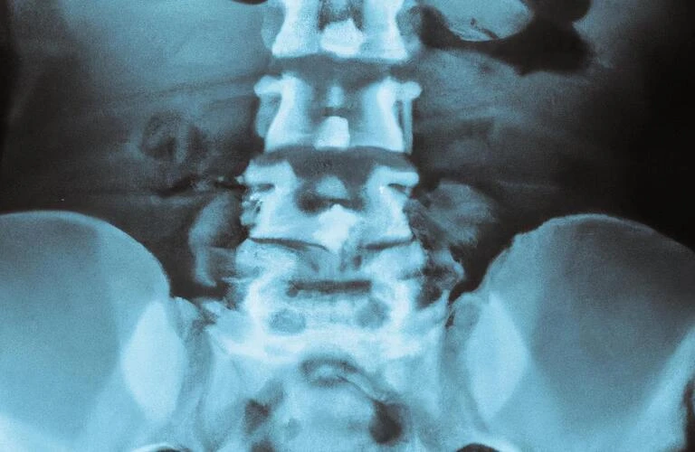 脊柱管狭窄症をしっかりケアして、快適な生活を手に入れましょう！