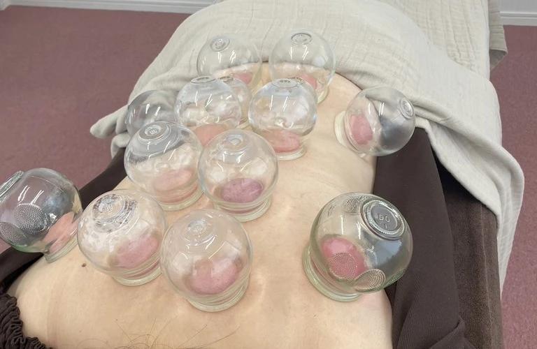 腰痛改善を目指す！カッピングと鍼治療で健康生活をサポート