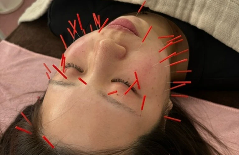 美容鍼で目指す若々しい顔立ち！たるみやむくみを改善し、自信を取り戻しましょう