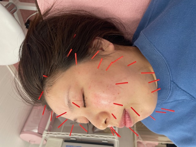 美容鍼で肌を生まれ変わらせる！