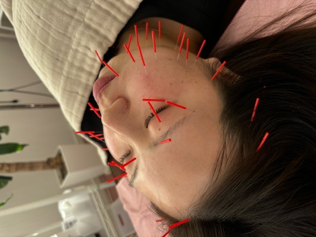 小顔ケアとしての美容鍼