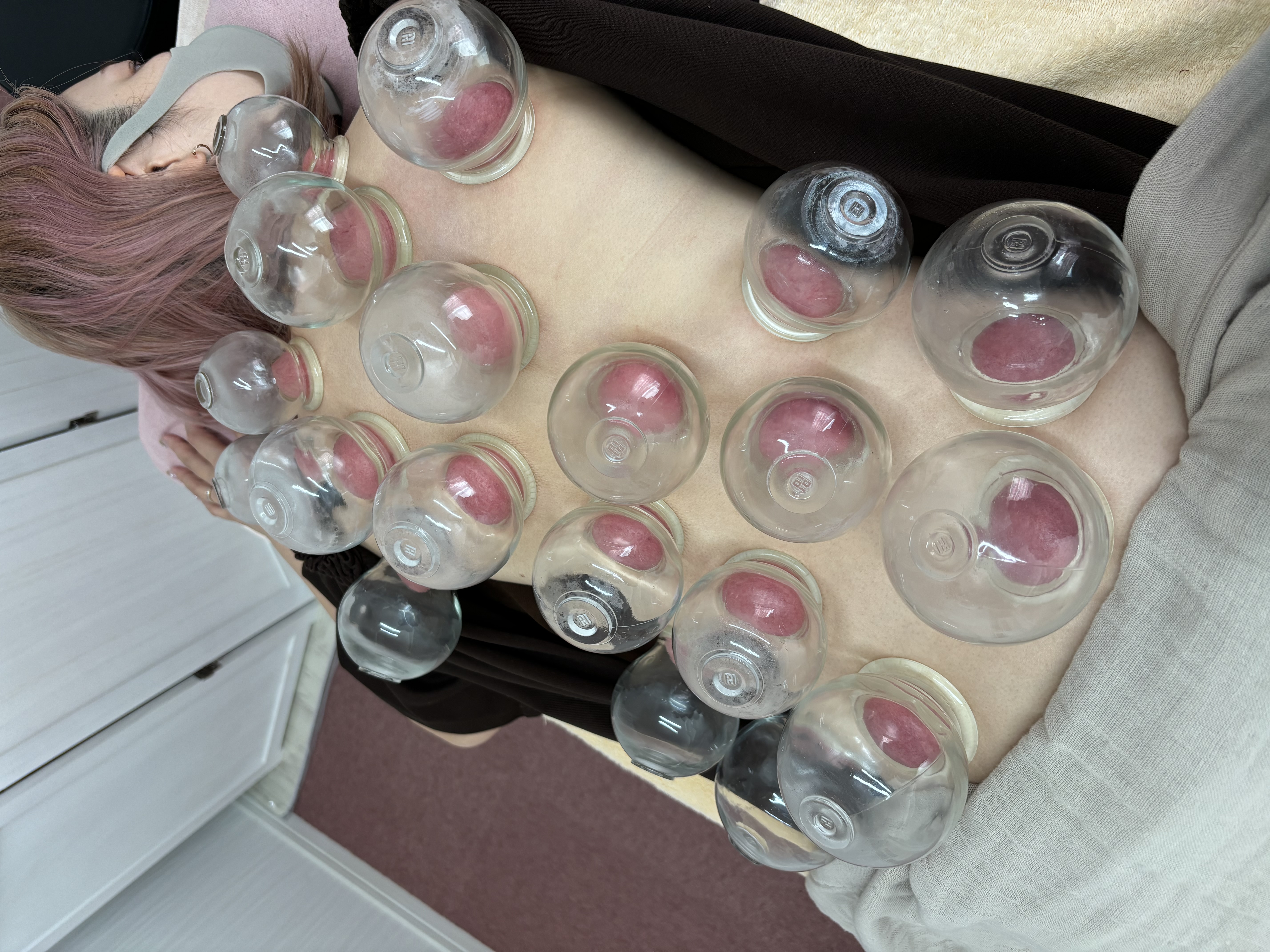 腰痛に悩むあなたへ。ガラス玉カッピングで新たな解決策を。