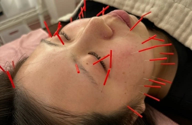 むくみを根本から解消する美容鍼、あなたの美しさを引き出します！