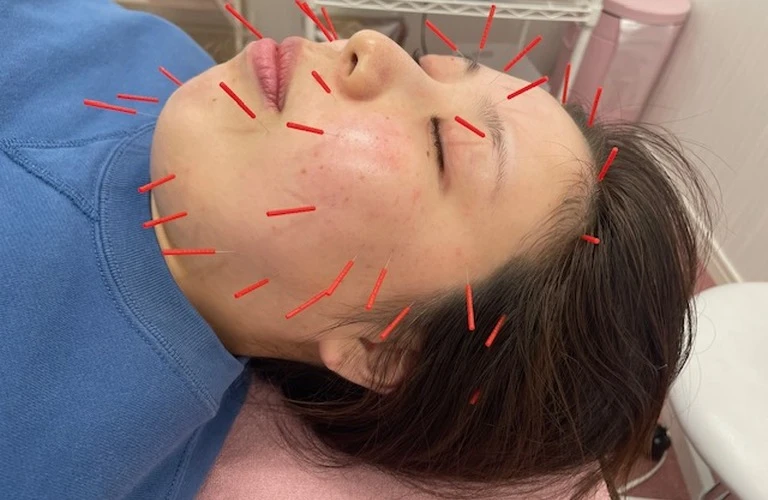 美容鍼で顔のたるみを改善し、自信あふれるあなたへ