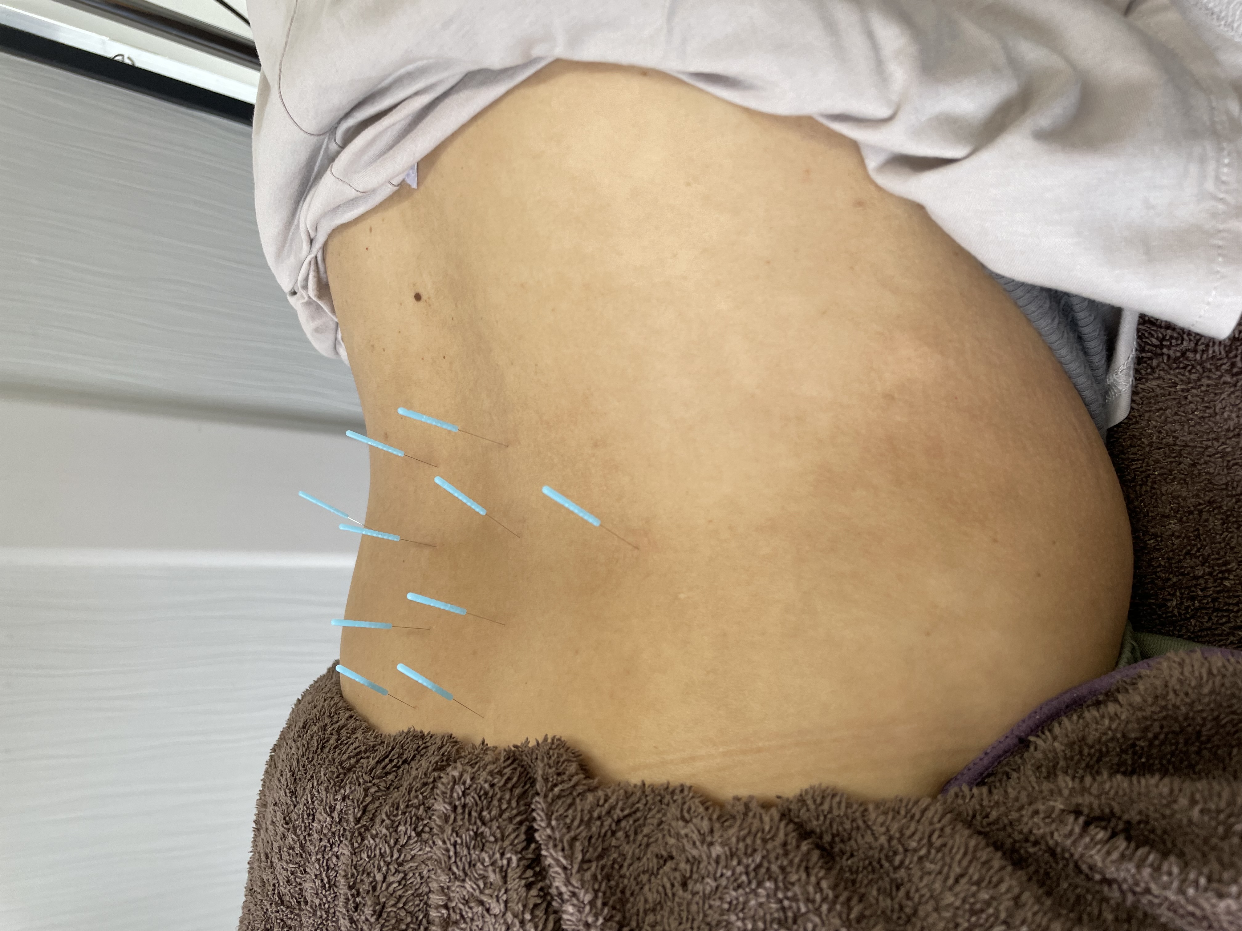 慢性的な腰痛を根本からアプローチする整体と鍼灸の融合