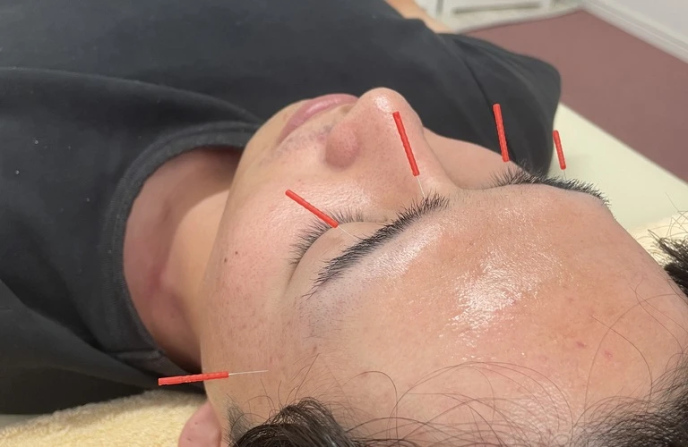 くすみを忘れる！美容鍼でさらさらの肌を手に入れよう