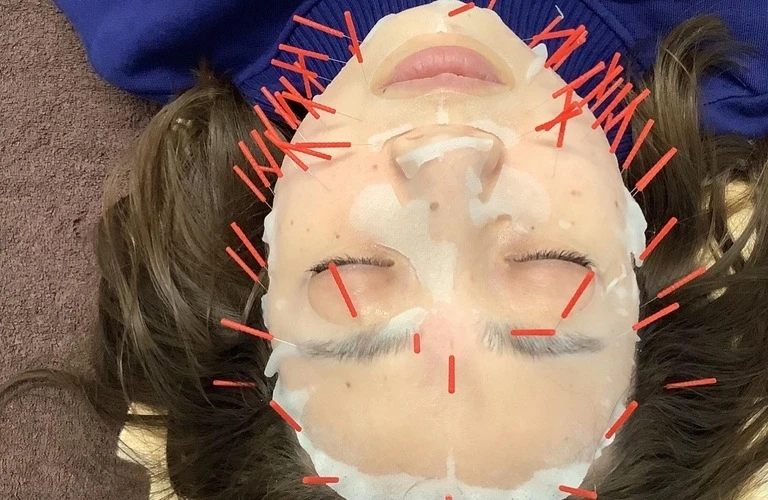 自分だけの美を追求するための美容鍼体験