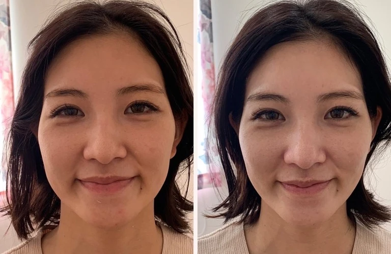 美容鍼でたるんだ肌をリフトアップし、ほうれい線をスッキリ解消！