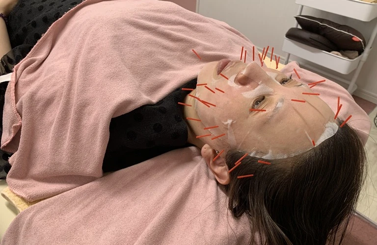 美容鍼で小顔を手に入れ、顔のたるみやむくみを解消しよう！