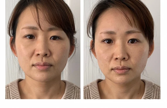 若々しさを取り戻す！美容鍼で顔のたるみを解消