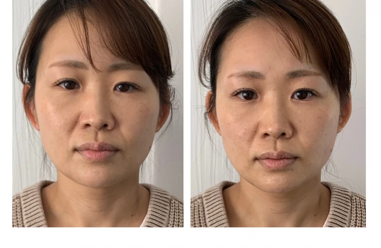 若々しさを取り戻す！美容鍼で顔のたるみを解消