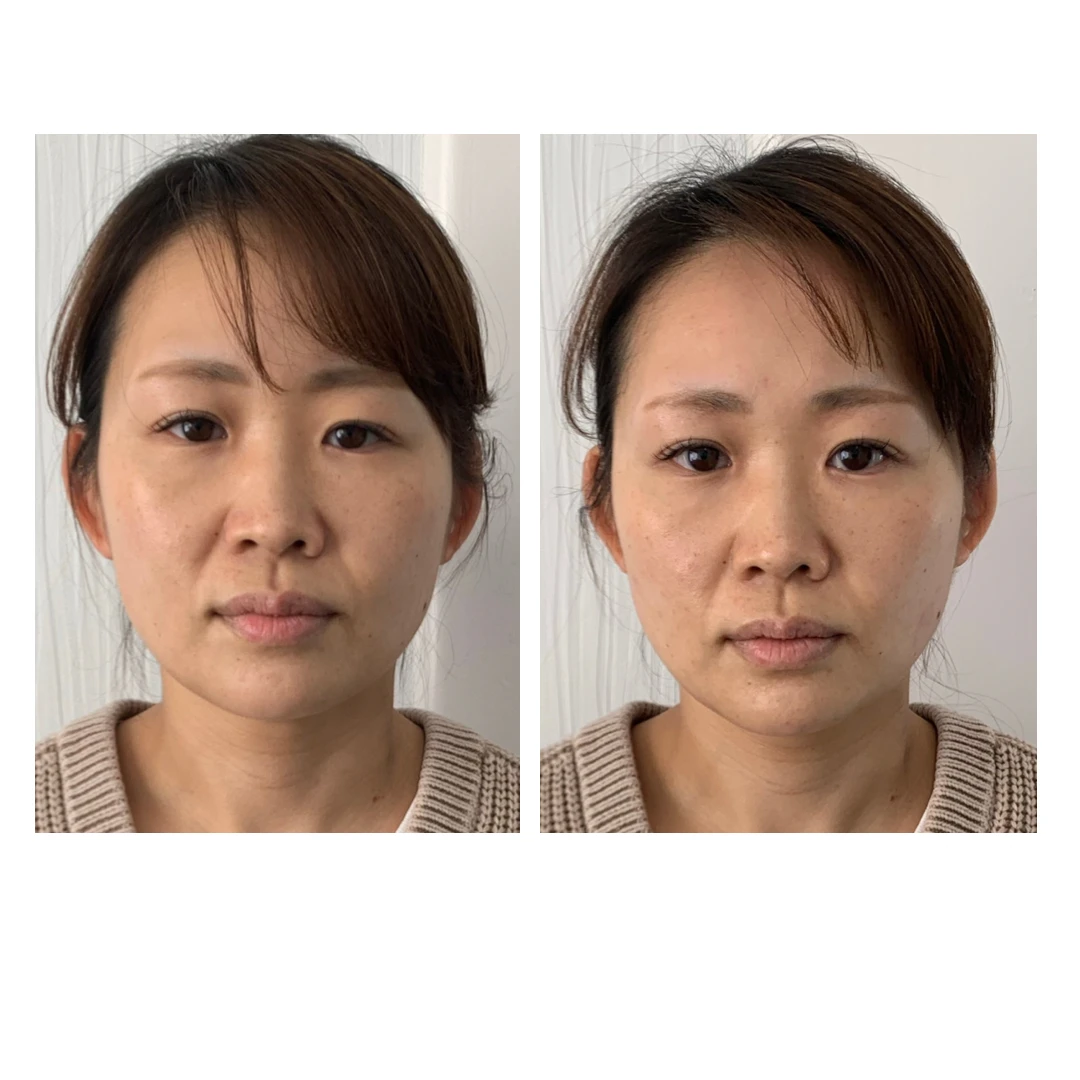 若々しさを取り戻す！美容鍼で顔のたるみを解消