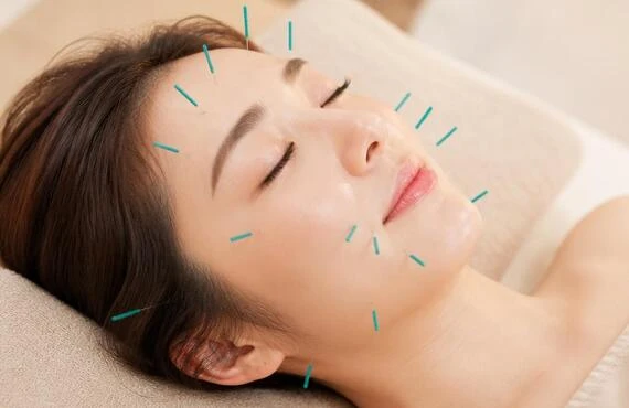 美容鍼で若々しい顔を取り戻す！