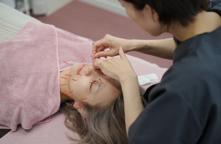 逆エイジング効果を実感！美容鍼でたるみとむくみを解消しよう